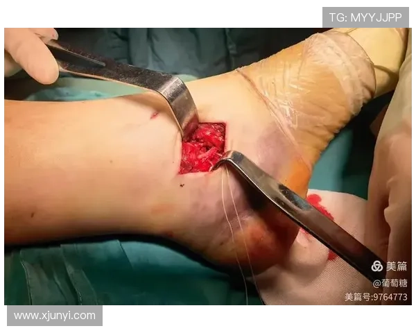 勒阿弗尔中卫小扎加杜十字韧损伤